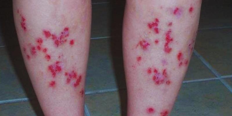 Understanding the Warning Signs of Morgellons Disease: A Comprehensive Guide