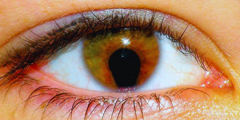 Effective Symptom Treatments for Cat Eye Syndrome: A Comprehensive Guide