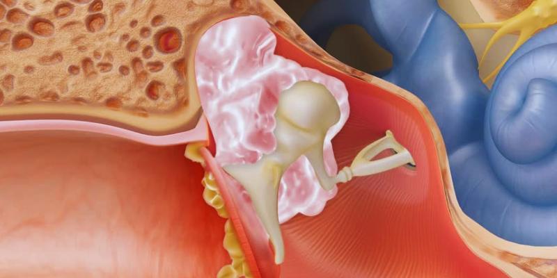 Diagnosing and Treating a Cholesteatoma: Everything You Need to Know